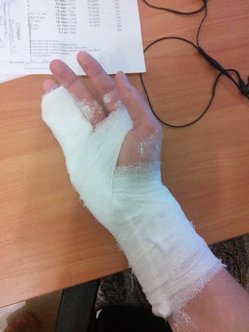 Ảnh đứt tay tập trung vào đường rách mảnh với máu chảy thành vệt ngắn.