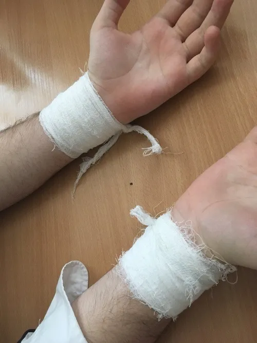 Ảnh xước tay ghi lại vùng da bị trầy đỏ cùng chút bụi bám tự nhiên.