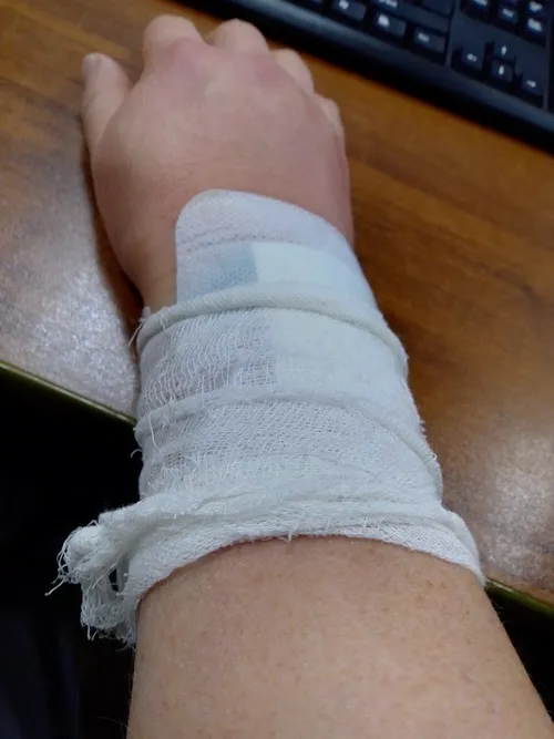 Hình chụp đứt tay làm lộ đường rách da và vùng đỏ ửng