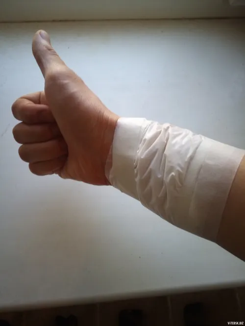 Ảnh sướt móng mô tả mép móng bị quệt vào vật cứng tạo vệt đỏ nhỏ.