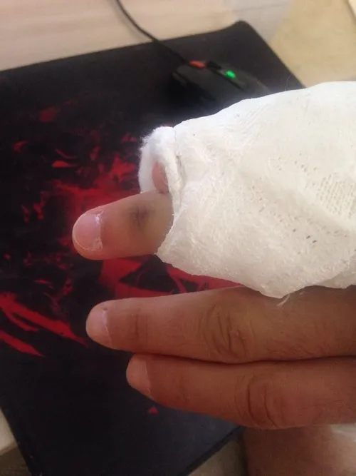 Ảnh đứt tay thực chụp sát cho thấy đường cắt và độ sâu vết thương