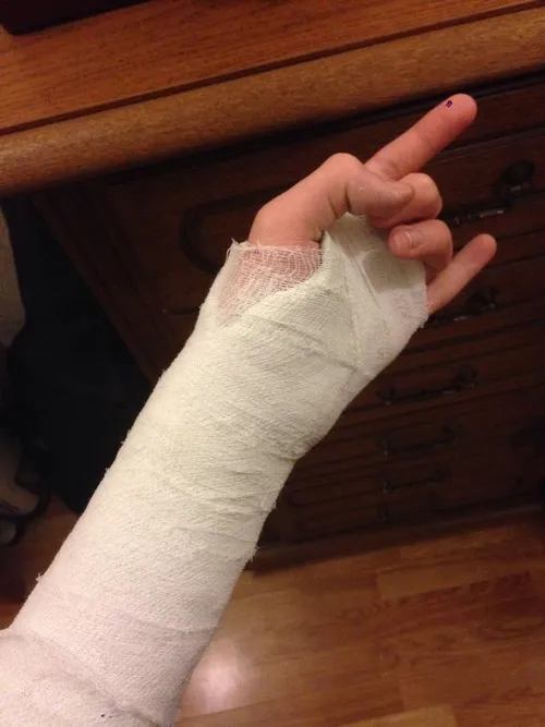 Ảnh đứt tay bắt cận cảnh vùng da sưng nhẹ quanh vết thương.