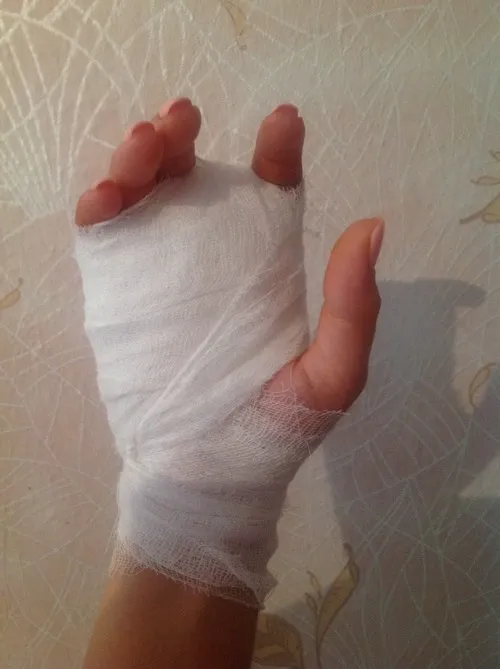 Ảnh đứt tay cho thấy mạch máu li ti lộ dưới lớp da đỏ ửng.