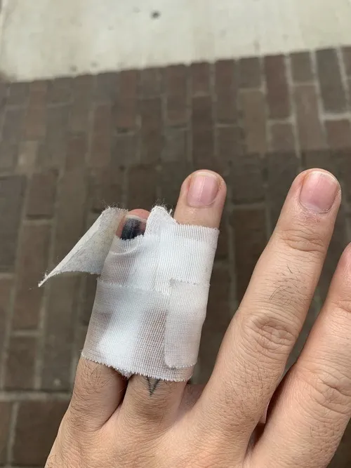 Ảnh thương nhẹ thể hiện phần da tổn thương hơi rát nhưng không quá sâu.