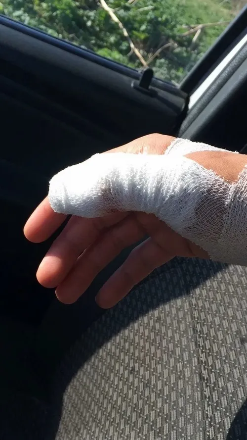 Ảnh đứt tay cho thấy người bị thương dùng khăn giấy ép nhẹ vết cắt.