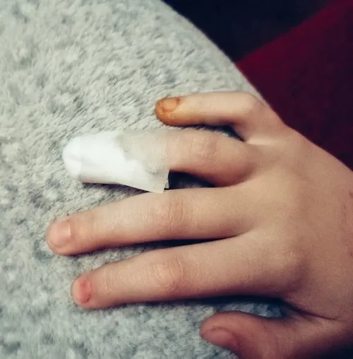 Ảnh đứt tay cho thấy bề mặt da hơi nhăn lại vì phản xạ đau.