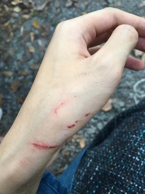 Ảnh rách da cho thấy vùng biểu bì bị kéo căng theo lực ma sát.