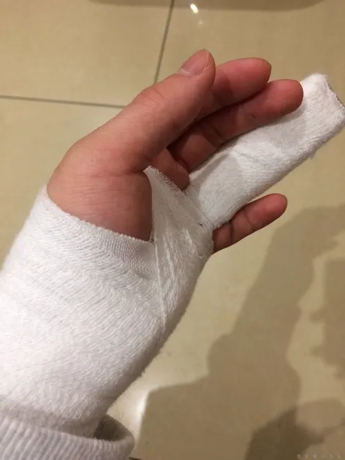 Ảnh sướt móng ghi hình mép móng bị tét ra một đường nhỏ.