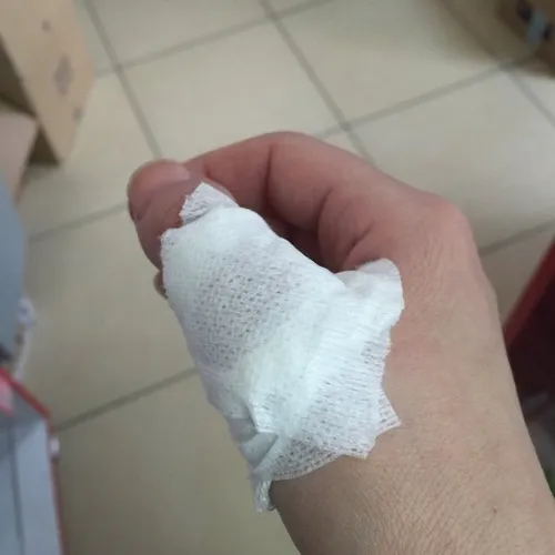 Ảnh đứt tay thể hiện cảm giác rát qua vùng da đỏ loang rộng.