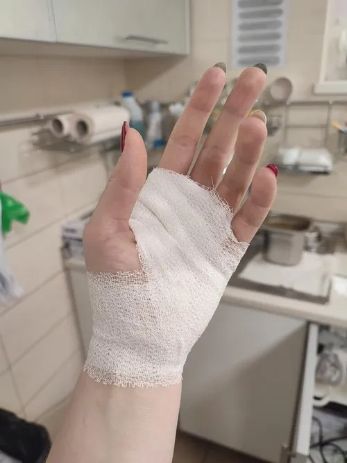 Ảnh thương nhẹ mô tả điểm sưng phồng nằm ngay cạnh vết trầy.