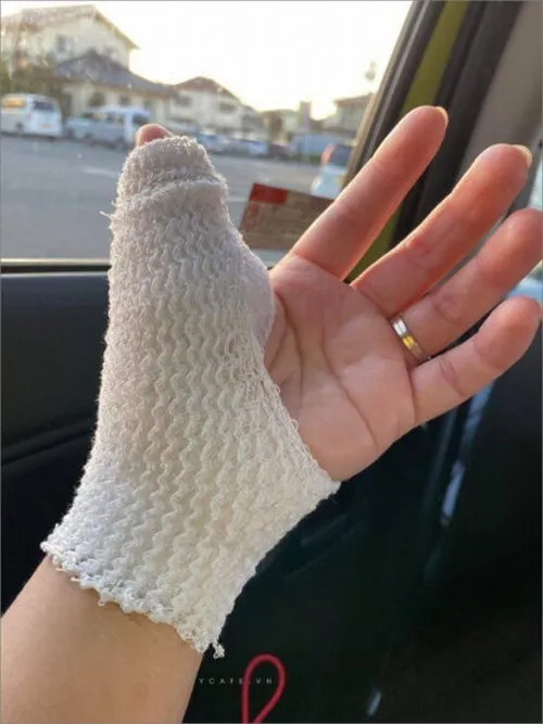 Ảnh đứt tay thực tế cho thấy vết thương sưng nhẹ quanh mép cắt