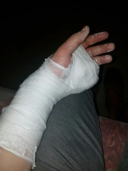 Ảnh đứt tay ghi rõ giọt máu đọng ở đầu ngón trông rất chân thật.